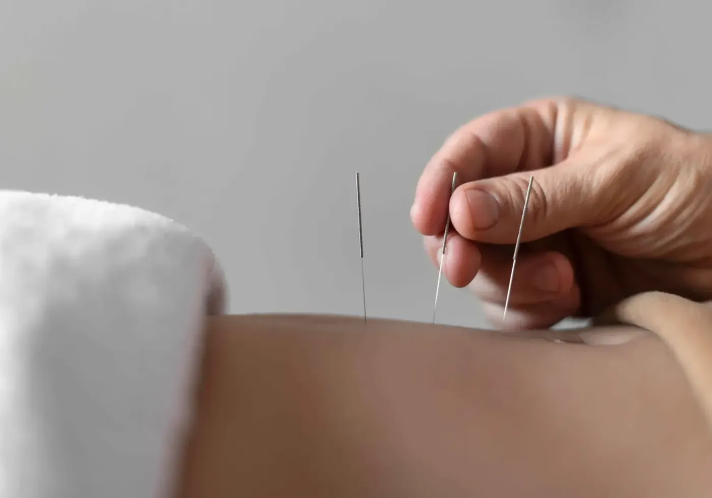Clinician performing dry needling trigger point treatment